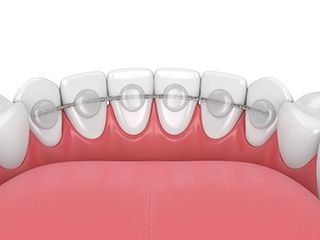 bonded retainer bonded retainer