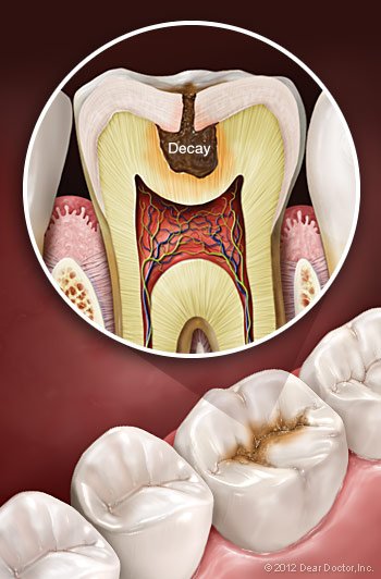 Tooth Decay.